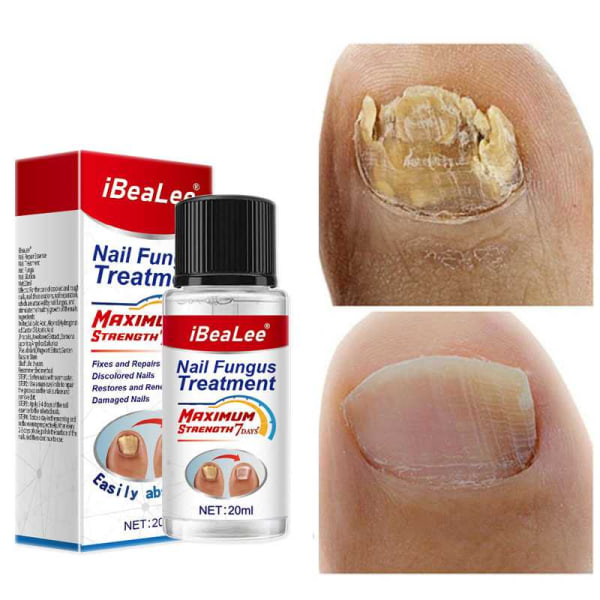 Tånagel för tånagel eller fingernagel Nagelreparationslösning Nagelförnyande vätska för skadad missfärgande nagel