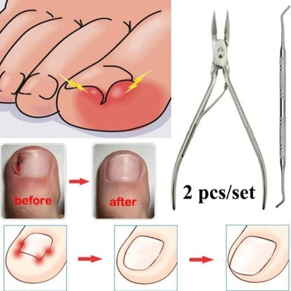 2st Inåtväxande tånaglar Pedikyr Fotvårdsverktyg Nagelkorrigering C one size