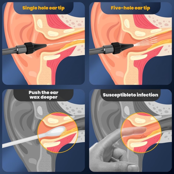 Öronvaxavlägsnande - Elektrisk öronrengörare - Öronrengöringskit - Öronbevattningskit Säkert öronbevattningssystem med 4 tryckinställningar - Effektiv