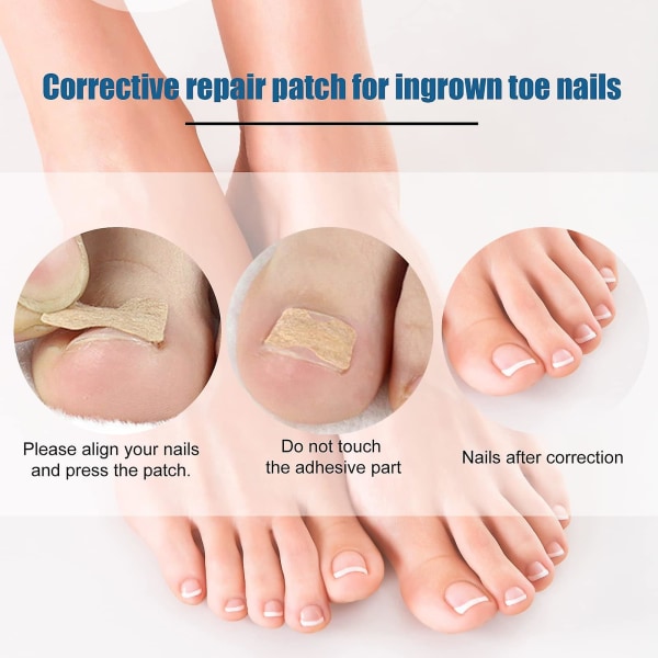 Korrigeringsplåster för inåtväxta tånaglar, 100 st Nagelkorrigeringsdekal Limfri tånagelkorrigeringsplåster för inåtväxta tånaglar Fotvårdsbehandling