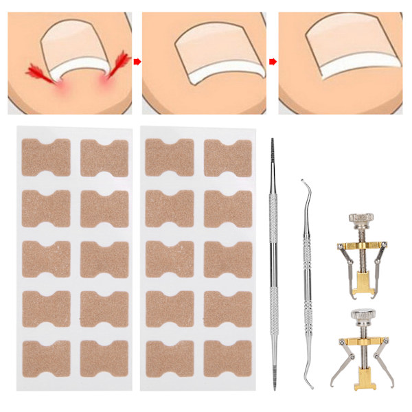6st/set verktygssats för korrigering av inåtväxta tånaglar Paronychia Toe Nail Fixer Pedikyrverktyg
