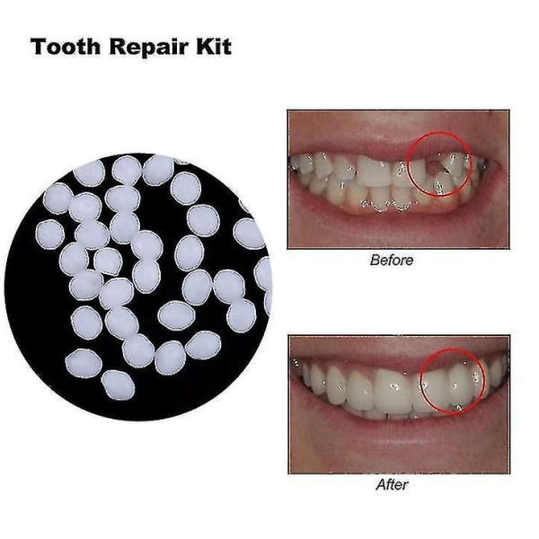 10g/100g tand- och rymdprotes fast lim hartsprotes vidhäftande tandläkare tandprotes fast lim temporärt tandrestaureringssats (50g)