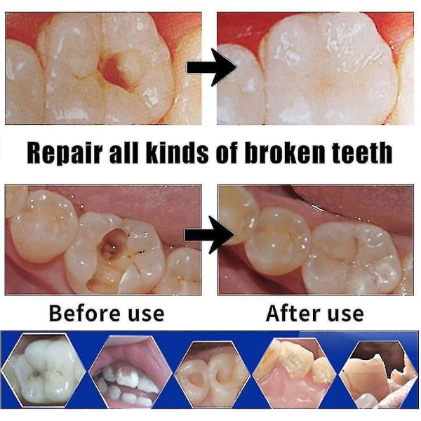 Reparation af cementtændergab Falsetænder Fast limsæt Tandfyldningssæt Midlertidige dental falske tænder Lim Tandhuller reparationssæt