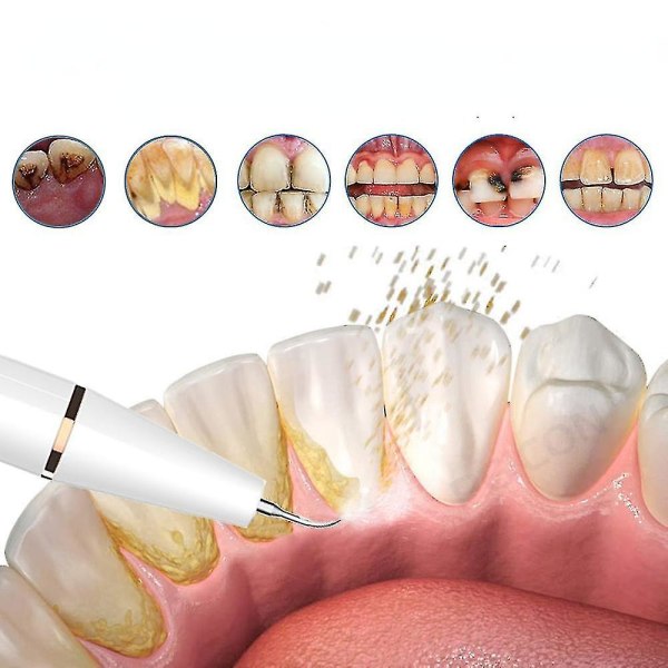 Plackborttagare för tänder Tandrengöringssats för borttagning av matrester Tandsten Munvård hemma Vit