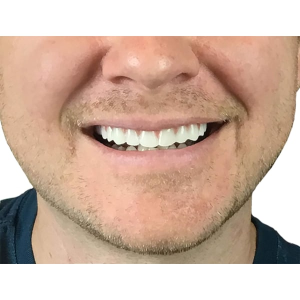 Natural Shade - Upper Veneer Cosmetic Teeth