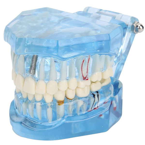 Anatomisk Tandmodell - Tandprotes Blue