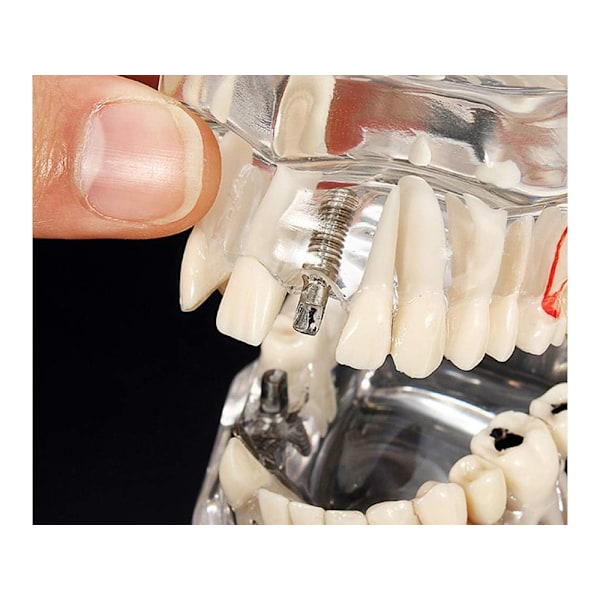 Anatomisk Tandmodell - Tandprotes Blue