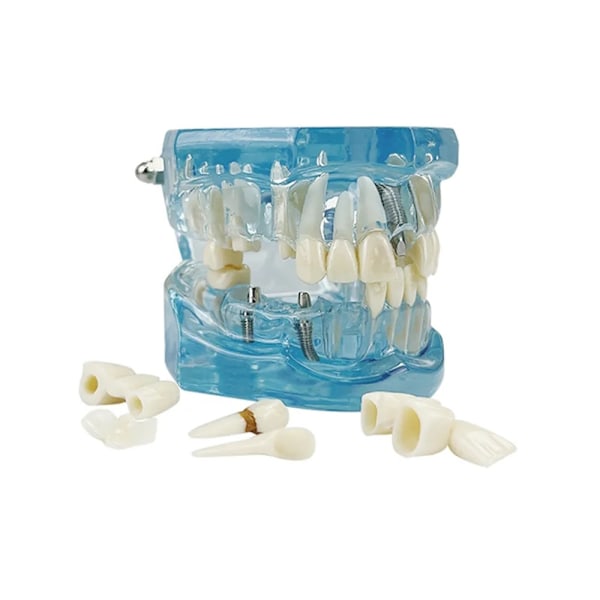 Anatomisk Tandmodell - Tandprotes Blue