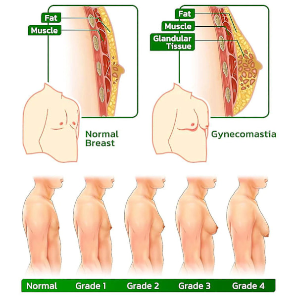 Gynecomastia Kompresjonsplaster - Turmericmax, Cellulitt-Smelting, Ginger-Strammende 1 box 12 Pcs