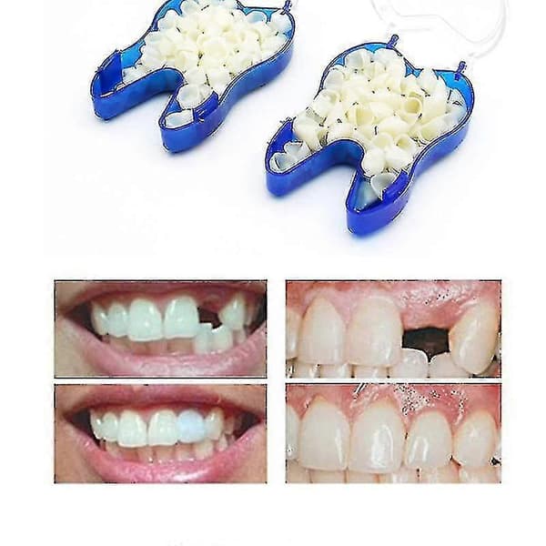 Temporary Denture Fasteners that Occlude Upper Dentures, Veneer Dentures, Missing Teeth, Broken Teeth, and Gaps Between Teeth (75% Discount)_FE06