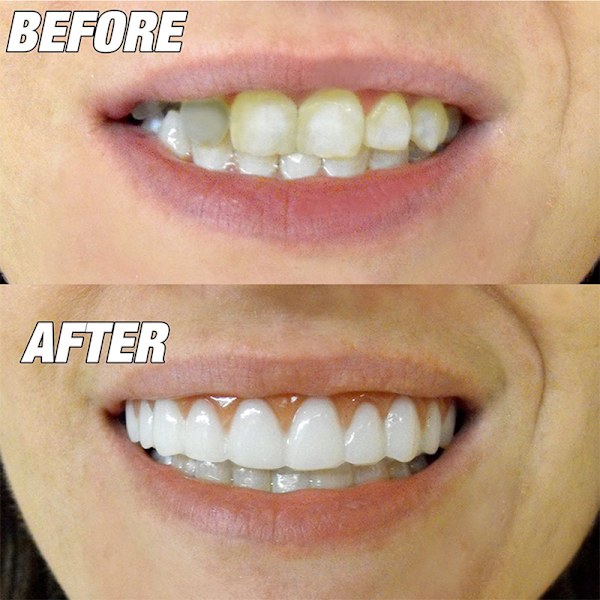 Sikker Instant Smile Øvre - One Size Fits Most