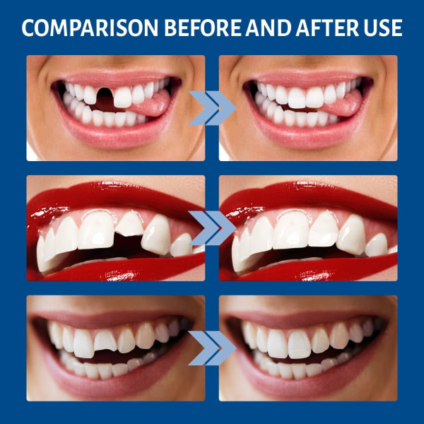 Tillfälliga dentala restaureringssatser - Thermal pärlor eller proteslim för att fylla, reparera saknade och trasiga tänder Tandproteser - Plastbitringar