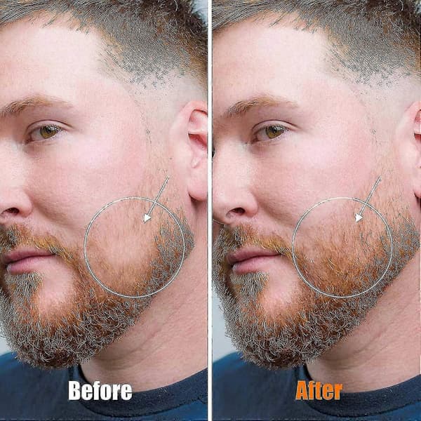 Skæg Derma Roller Microneedle Roller til skægvækst - 0,25 mm