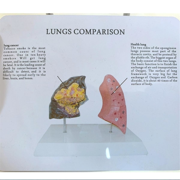 Tupakoitsijan keuhkomalli Terve keuhkomalli Keuhkojen anatomiamalli patologisen hengityselimistön sairauden kanssa