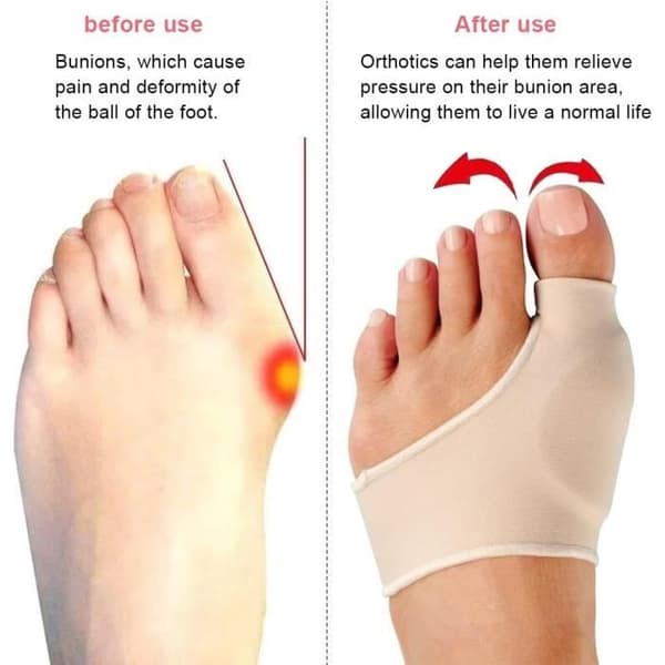 Par Hallux Valgus Korrigerer Dag Natt, Stor Tåretting