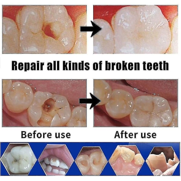 Reparation af cementtandspalter, kunstige tænder, fast lim, sat tand KLB
