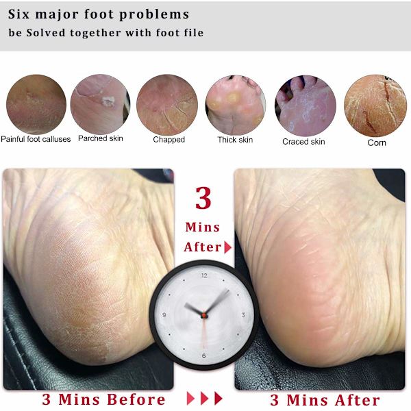 Fotfil Callus Remover Fotskrubb, Professionell Pedikyr Fotrasp Tar Bort Sprickade Hälar, Död Hud, Liktorn, Hård Hud