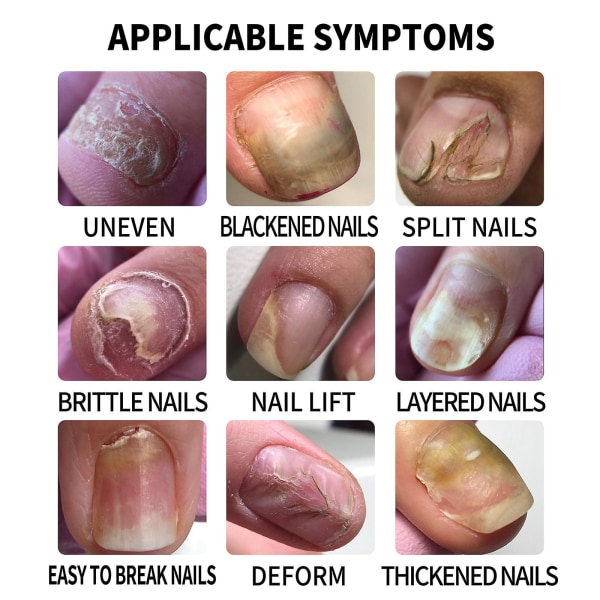 Grå Nagelreparationsvätska Nagelslättande Essens Mjuk Nagelförtjockning Grå Nagel Uppljusande Nagel