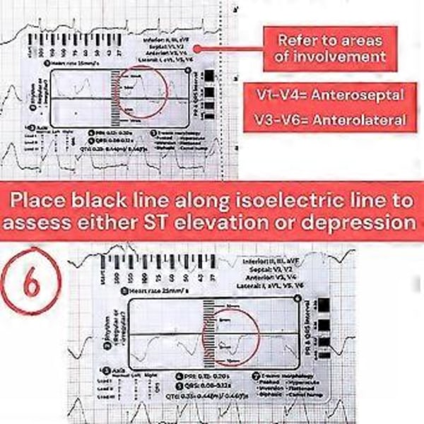 Liten Elektrokardiogram 7-stegs Linjal Bekväm Kompakt EKG-linjal för Användning i Farten (Med fodral)