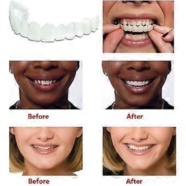 Smile Löständer, Temporära Ersättnings-Fanérkit för att Täcka Imperfekta Tänder