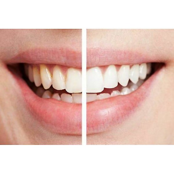 TG Remover Tandrengöring, Professionell Tandborttagning Tandfläcksuddare, Tandpoleringsrengöringssats tar bort plackföroreningar Whiteni