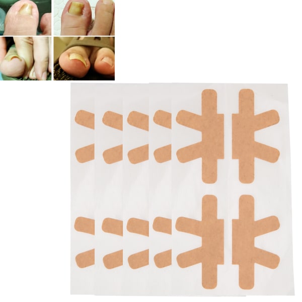 Inåtväxta tånagelkorrigerande klistermärken Pedikyr Tånagelvård Korrigeringsbandage