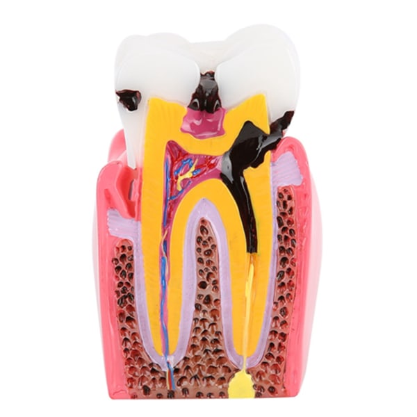 Karies sammenligning Study Models Tannlege Dental Anatomy Education Teeth Model