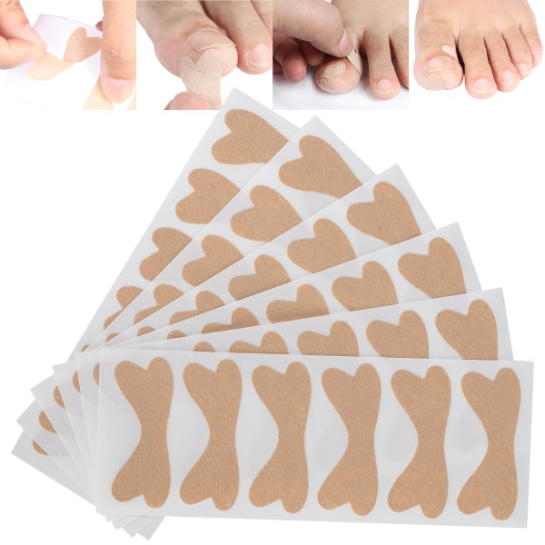 Profesjonell tåneglkorrigeringslapp Inngrodd tåneglkorreksjonsklistremerkesett Fotpleie36stk