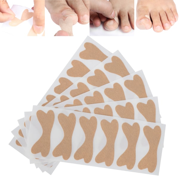 Profesjonell tåneglkorrigeringslapp Inngrodd tåneglkorreksjonsklistremerkesett Fotpleie 30 stk.