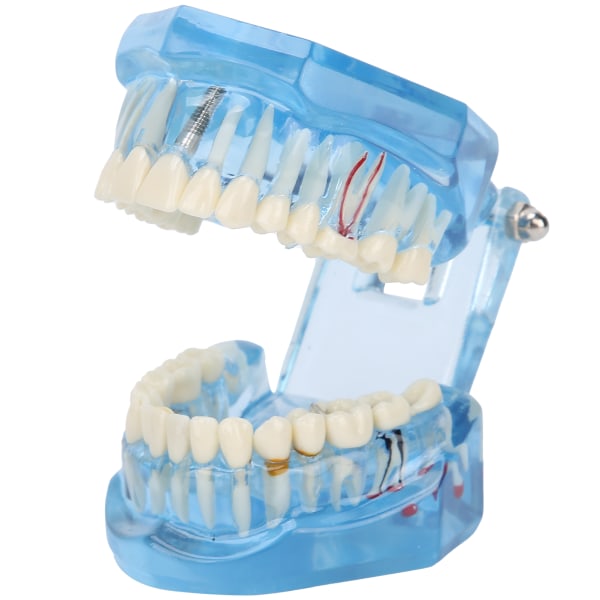 Tandtænder Model Akryl Blå Transparent Undervisning Demonstration Simulering Tænder Model
