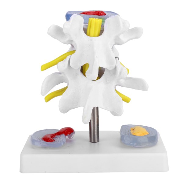 Anatomisk Lumbal Disc Herniation Demonstration Model Human Spine Skole Træningsartikler