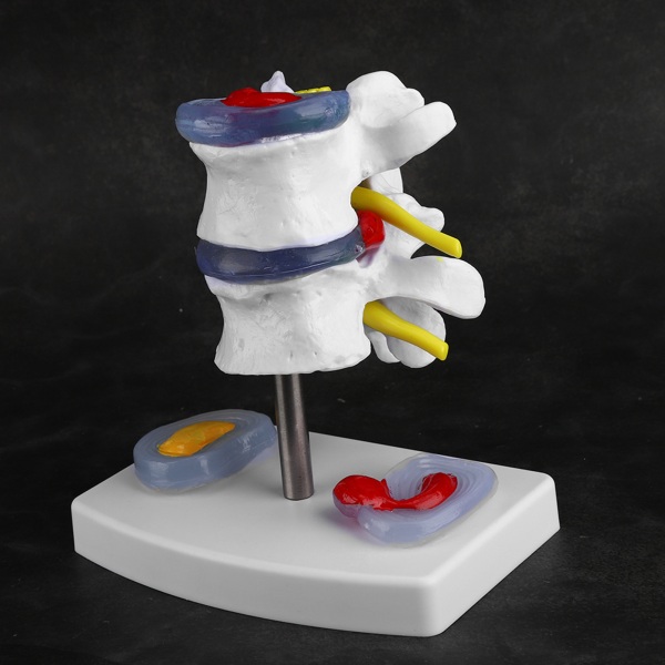 Anatomisk lumbal skiveprolaps Demonstrasjonsmodell Human Spine School Training Supplies