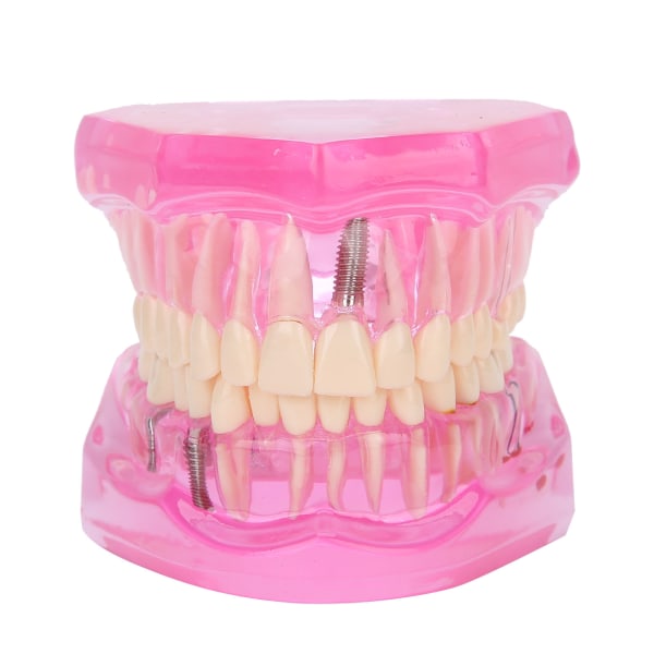 Gjennomsiktig voksen tenner Modell Patologisk reparasjon Studerer tannlegeundervisningsverktøy