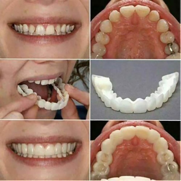 Dental Veneers Dentures Tann Deksel Sett - Snap On Falske Tenner (Nedre & Øvre)