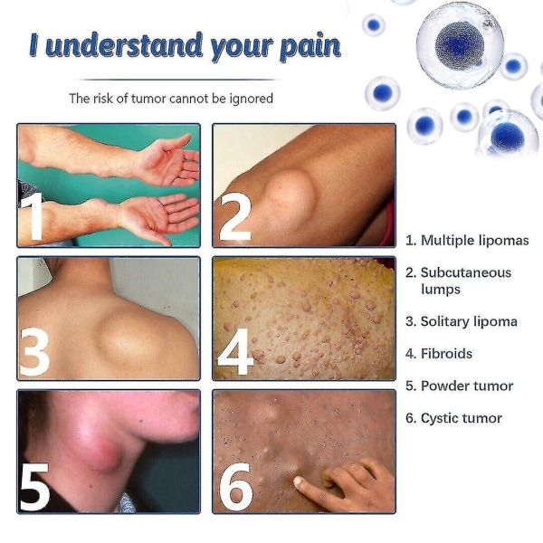 50 Ml Lipoma Removal Spray Urteeksfolierende Hud Anti-hævelse Smertelindring