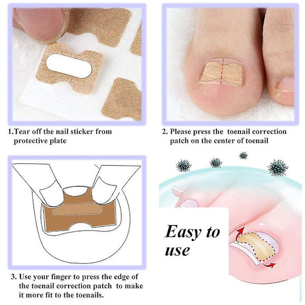 Nageltrångs Stickers, 20-pack Limfri Nagelförbättringsplattor