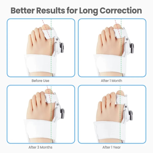 1* Hallux Valgus Corrector, Hallux Valgus Toe Separator - Vit