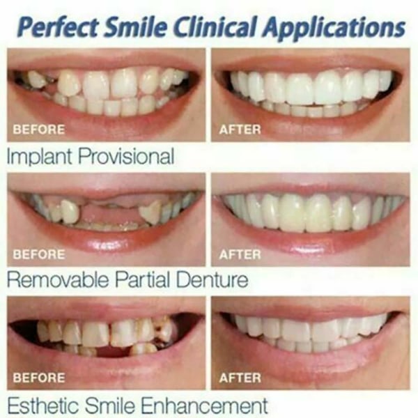 Perfect Smile Brace Fäst på övre falska tänder Dental Faner Protes Cover Set