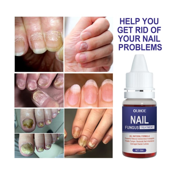 Nagelreparation Antibakteriell lösning Snabbverkande nagelmissfärgningsbehandling för svaga spruckna delade naglar default