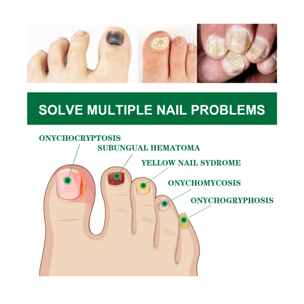 10 ml Nail Repair Antibakteriell lösning som behandlar nagelmissfärgning och nagelfall för trasiga spruckna och svaga naglar default