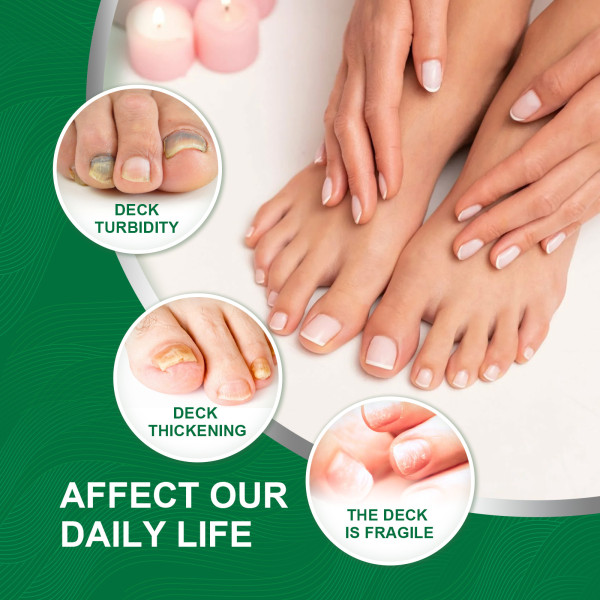 10 ml Nail Repair Antibakteriell lösning som behandlar nagelmissfärgning och nagelfall för trasiga spruckna och svaga naglar default