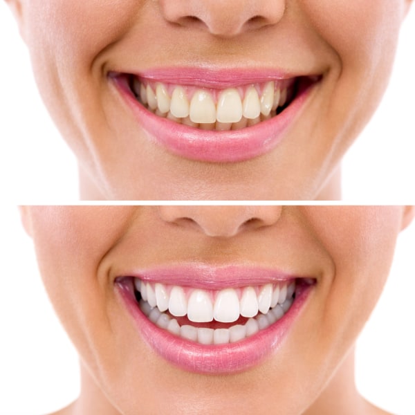 Tandblekning Hemma Dental 360 Strips Enkel Tandblekning 180 Pack