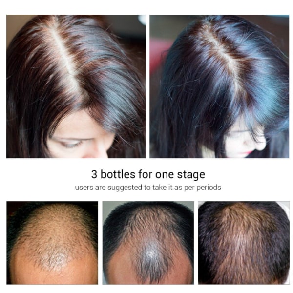 Behandling av Hårväxt tunt hår naturligt minskar håravfall 1 flaska