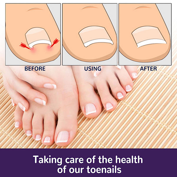 50 st inåtväxta tånagelkorrigeringsdekal Nail Strip Corrector St