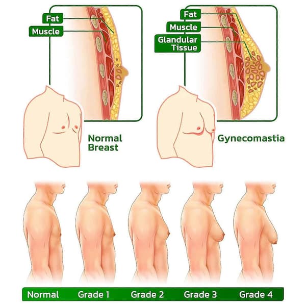 Gynekomasti Kompress Patch - Turmericmax, Ingefær Patch for Cellulittsmelting 1 box 12 Pcs