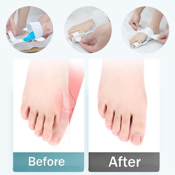 Hallux Valgus Separator Corrector Rails til lindring af smerter til mænd og kvinder i universel størrelse