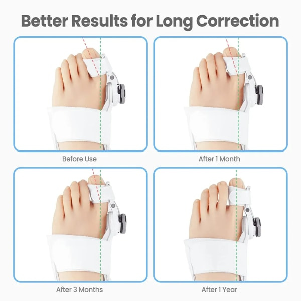 1* Hallux Valgus Korrigerare, Hallux Valgus Tåseparator - Vit