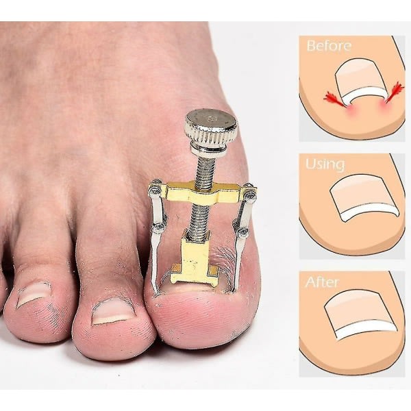 Nagelinläggskorrigerare, tånagel med långt och kött, nageluträtare, nagelräta med lockande nagelplatta
