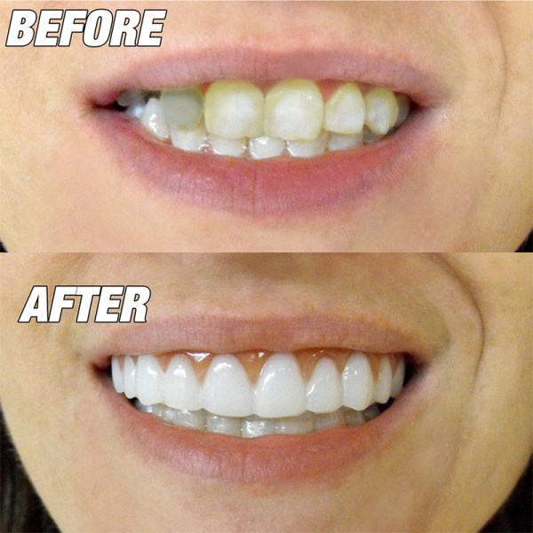 Förpackning med 5 ljusa vita toppfaner kosmetiska tänder