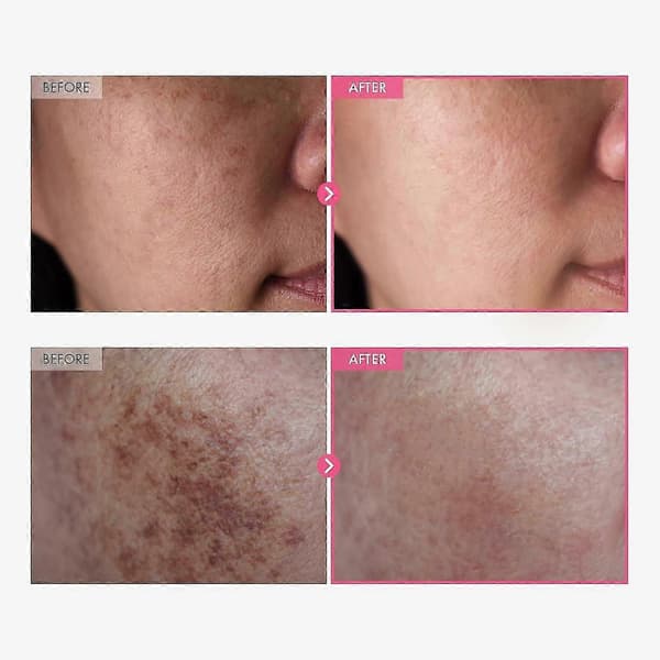 1-5x Arbutin 7% + Tranexamsyra 4% Kräm 50g (5ST)